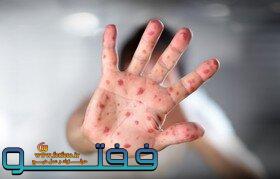 مورد قطعی ابتلا به سرخک در رفسنجان و انار شناسایی نشده است