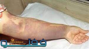 هشدار در مورد شیوع بیماری تب کریمه کنگو در رفسنجان