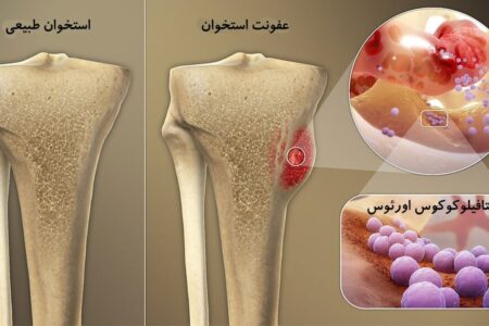 "سیمان آنتی بیوتیکی" برای جلوگیری از عفونت استخوان ابداع شد