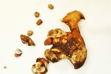 برداشت سنگ کلیه شاخ گوزنی باجراحی نفرولیتوتومی در فاریاب