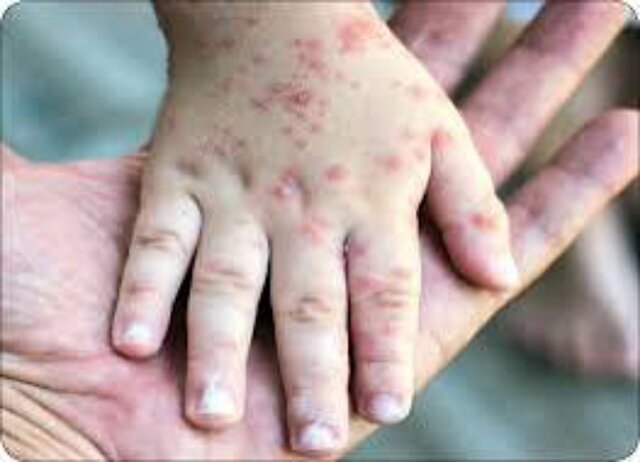 مراقب آبله مرغان باشید | اخبار کرمان و شهرستان ها