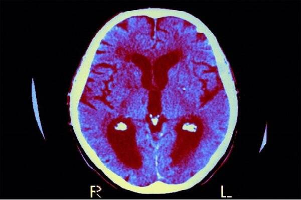 فراموشی زودهنگام در کودکان؛ پای سرب در میان است