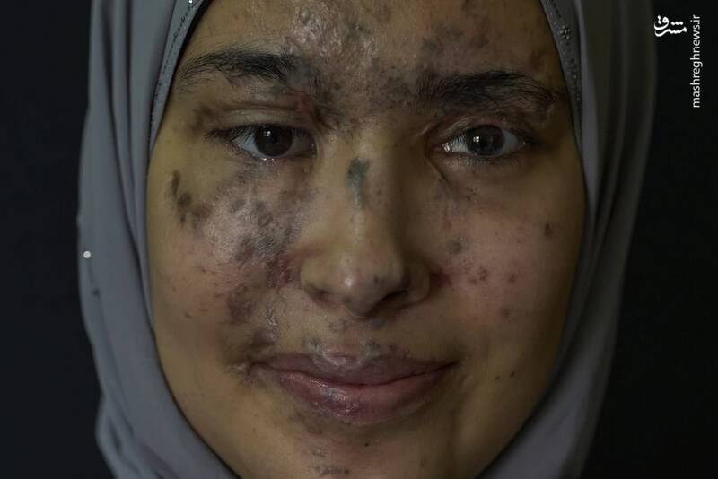 عکس/ روایت‌های ناتمام قربانیان انفجار پیجرها