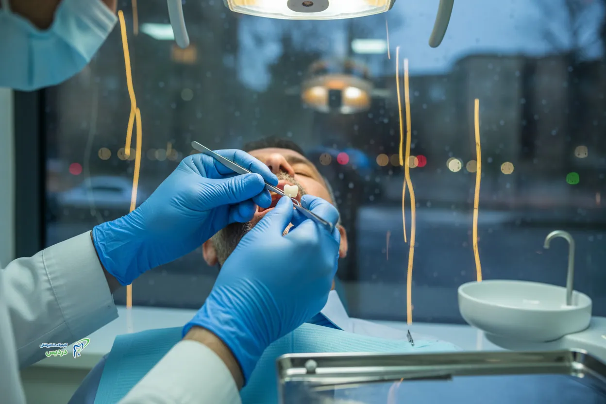 مراحل ایمپلنت دندان از مشاوره تا نصب روکش نهایی (راهنمای کامل بیمار)