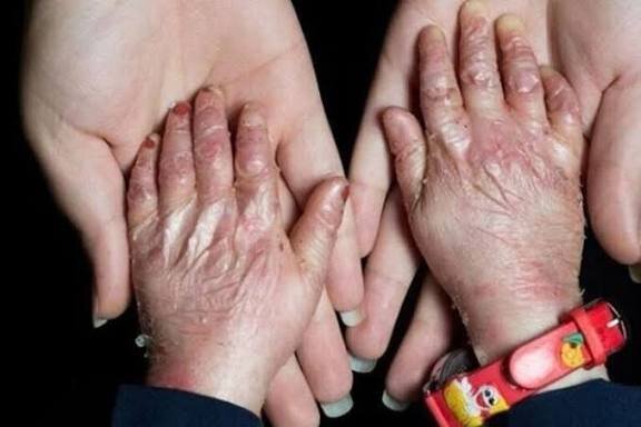 هزینه‌های سرسام‌آور و محدودیت دسترسی به دارو، زندگی بیماران نادر را سخت‌تر کرده است | اخبار کرمان و شهرستان ها